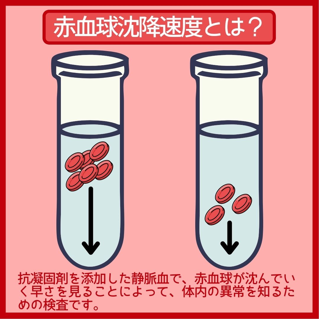 赤血球 沈降 速度 が 低下 する の は どれ か